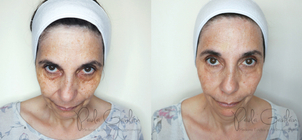 tipos de ojeras