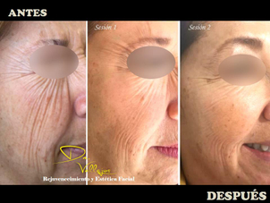 antes y después de mesoterapia